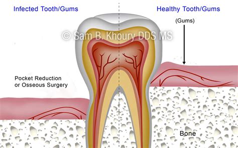 Gum Disease Surgical Procedures Pocket Reduction Surgery