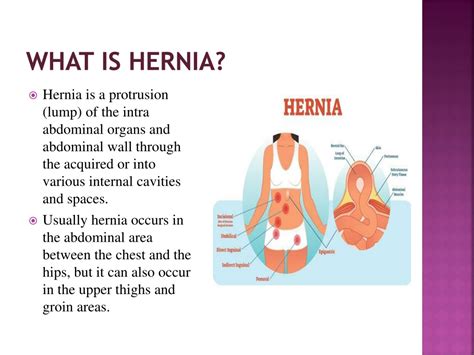 Ppt Everything You Need To Know About Hernia Powerpoint Presentation