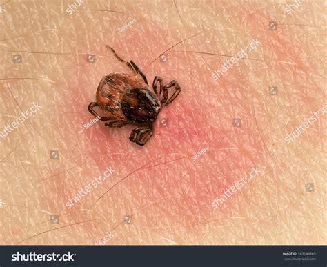 Tick With Its Head Sticking In Human Skin Red Blotches Indicate An