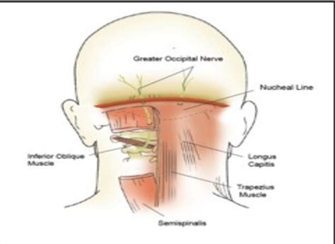 Figure From Suboccipital Decompression For Occipital Neuralgia My XXX