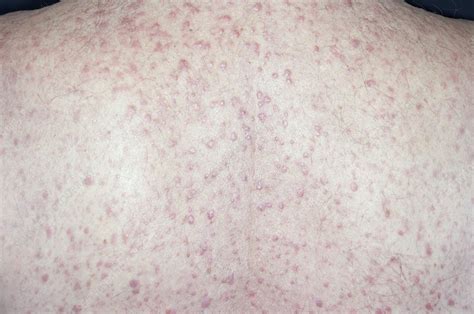 Eczema On The Back Stock Image C0111669 Science Photo Library