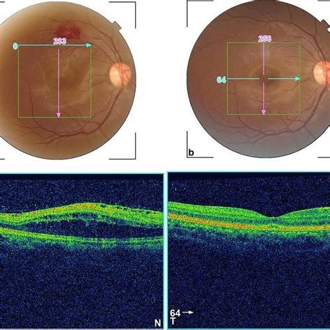 A Color Fundus Photograph And Oct Of A Patient With Superotemporal Rama