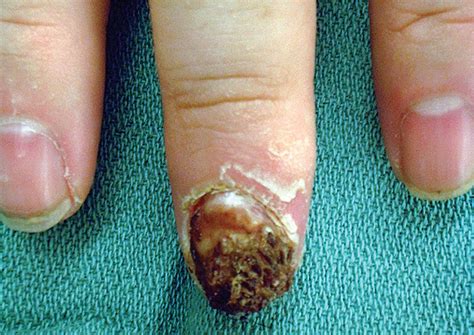 Skin Cancer Of The Hand Carolina Hand Center