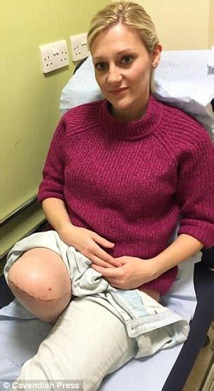 Dorset Mortgage Worker Watched Her Leg Explode After Crash Daily Mail
