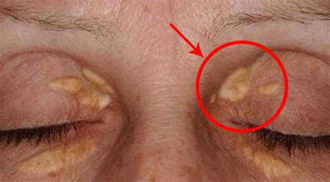 Cholesterol Deposits On Eyelids And Around Eyes Xanthelasma Dr Sam