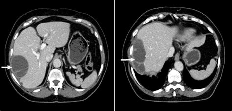 Abdominal Ct Showing A Large Subhepatic And Perihepatic Fluid