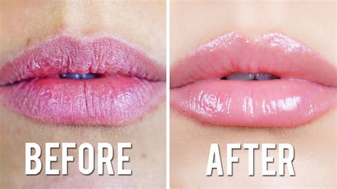 What To Do Extremely Dry Lips After Filler