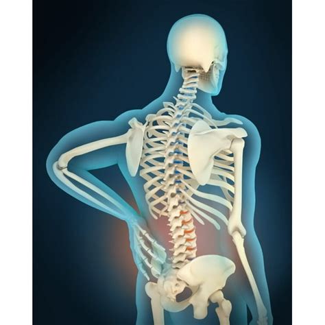 Medical Illustration Showing Inflammation And Pain In Human Back Area