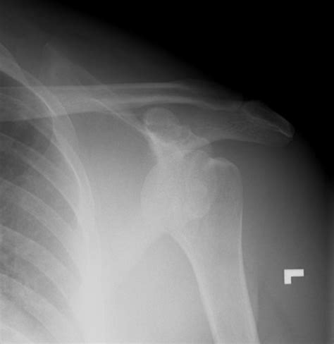Musculoskeletal Radiology of Fractures