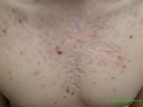 Acne And Acne Scarring Ioulios Palamaras Md Phd