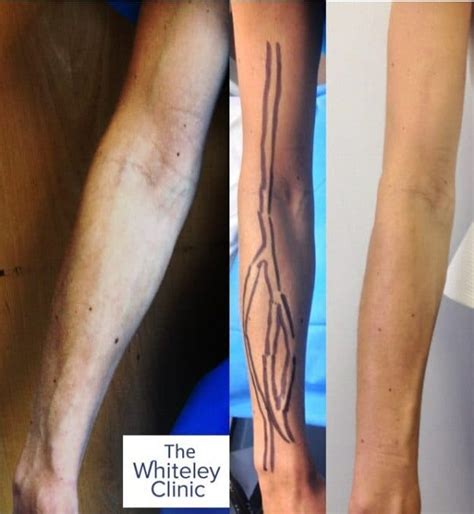 Arm Veins Removal The Whiteley Clinic