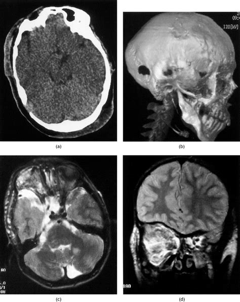 Calvarial Masses Of Infants And Children A Radiological Approach