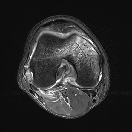 Hyperextension Knee Injury Image Radiopaedia Org