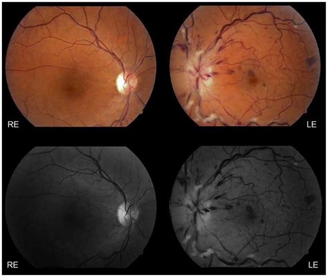 Color And Red Free Fundus Photography Of The Right And Left Eye