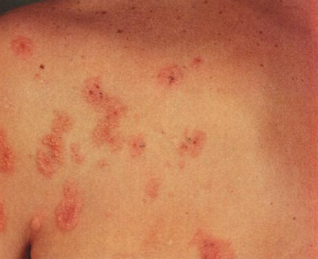 Dermatitis Herpetiformis Scalp