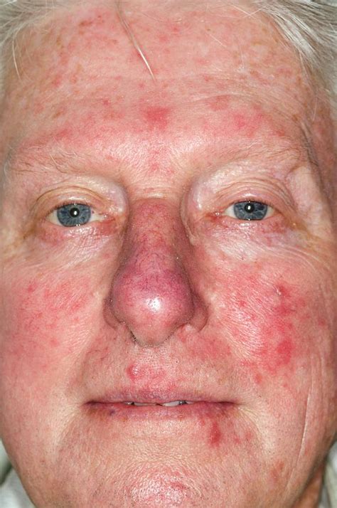 Acne Rosacea On The Face Photograph By Dr P Marazziscience Photo Library