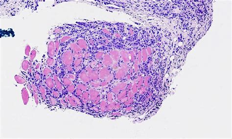 Pathology Outlines Mesothelioma Pleura Epithelioid