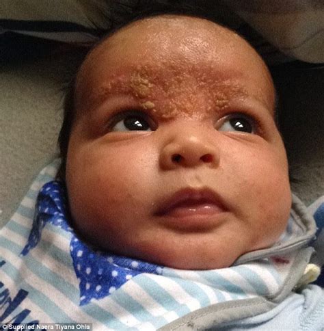 Mother Reveals How Change In Diet And Miracle Cream Helped Cure Babys