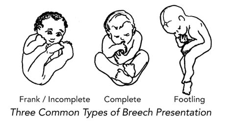 My Breech Baby How To Turn A Breech Baby