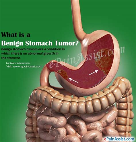 Causes Of Benign Stomach Tumors Its Symptoms And Treatment