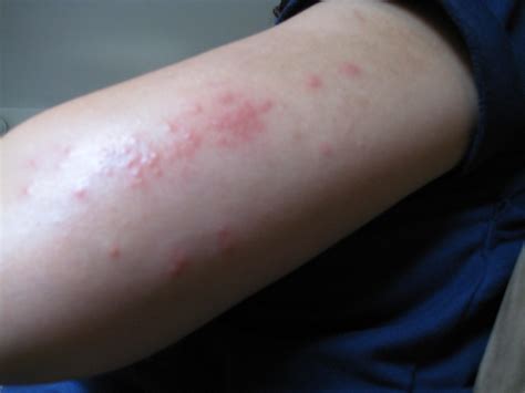 Whatareoverthecountertreatmentsforscabies What Are Over The