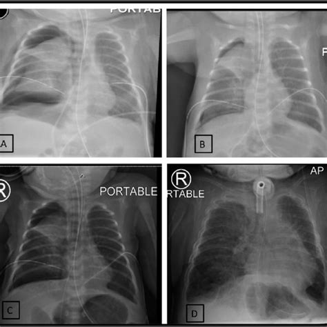 Chest X Rays A Chest X Ray On Day One Of Life Showing Bilateral