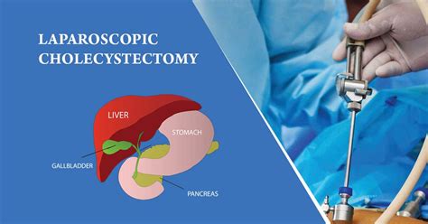 Laparoscopic Cholecystectomy Laparoscopic Surgery Gallbladder