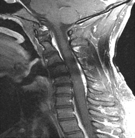 Mri Cervical Spine Without Contrast Shows An Abnormal Hypointense