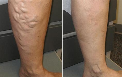 Effective Ways To Get Rid Of Varicose And Spider Veins