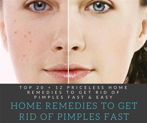 Search for health information from across the web with findhealthinfonow.com. Top 20 + 12 Priceless Home Remedies To Get Rid of Pimples ...