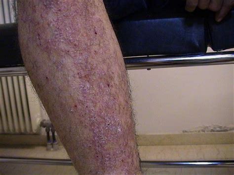 Dermatitis Ekzema Neurodermatitis Picture Hellenic Dermatological