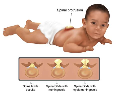 Spina Bifida Healthdirect