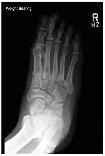 Excision Of Tarsal Coalitions Musculoskeletal Key