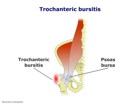 Bloomsbury Health Centre Trochanteric Bursitis Hipp04