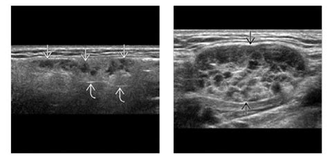 Left Longitudinal Grayscale Us Shows Focal Hypoechoioc Areas Within