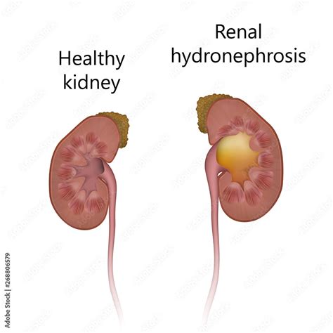 Healthy Kidney Comparison With Hydronephrosis Distended Renal Pelvic