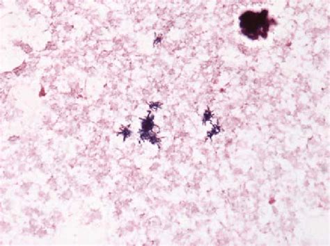 Gram Stain Performed On Blood Cultures Showing Branching