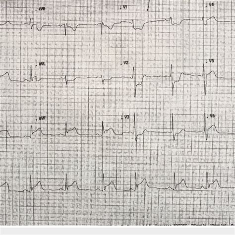 12 Lead Electrocardiogram Ecg With Evidence Of An Infero Posterior
