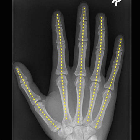 Hand Radiograph An Approach Radiology Blog Post