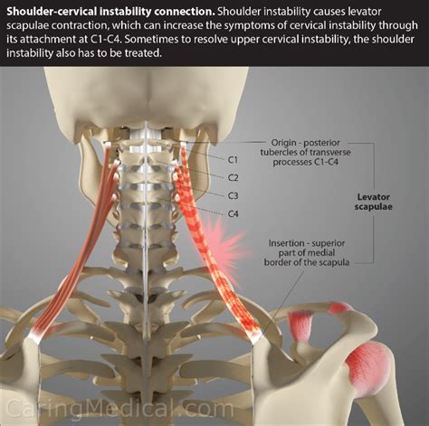 Is Neck Instability Causing Your Shoulder Pain