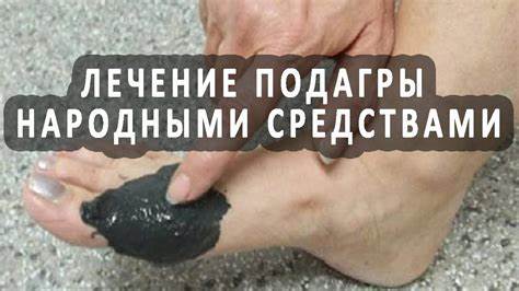 Лечение подагры народными средствами - YouTube Картинка - Лечение подагры народными средствами - YouTube