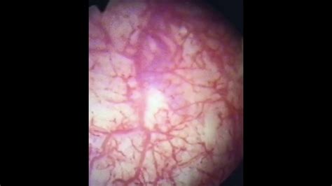 Cystoscopy Of Interstitial Cystitis Youtube