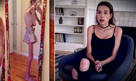 Anorexic Woman Finds Out What The Disease Has Done To Her Daily Mail Online