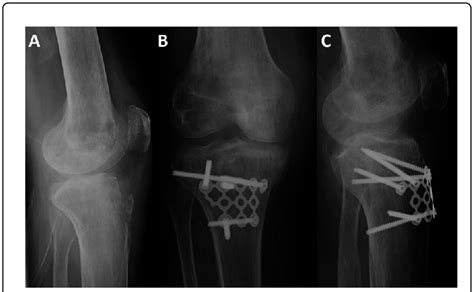 Radiograph Of A Tibial Tuberosity Fracture In A Fifty Year Old Male