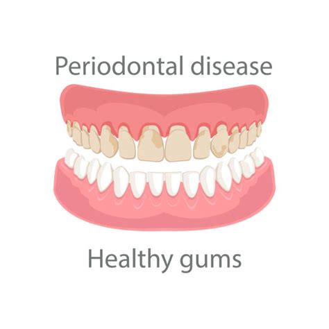 Gum Disease Illustrations Royalty Free Vector Graphics And Clip Art Istock