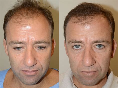 Hair Transplants For Men Fotos Miami Fl Paciente 58056