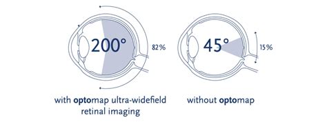 High Tech Eye Care How The Optos Ultra Widefield Retinal Imaging Dr