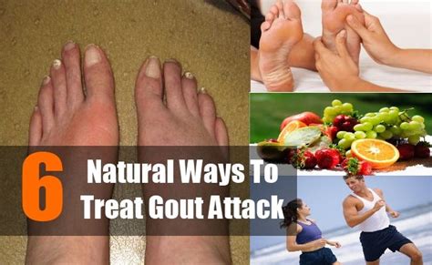 6 Natural Ways To Treat Gout Attack Gout Attack How To Cure Gout Gout
