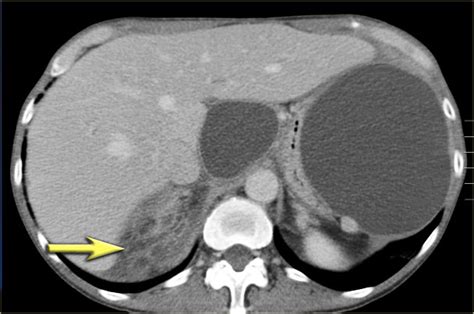 The Radiology Assistant Pancreas Cystic Lesions