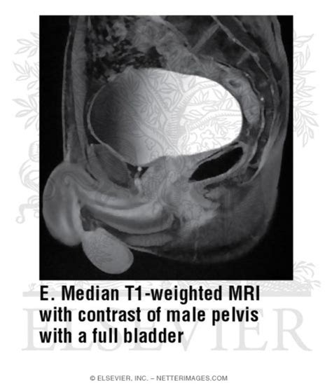 Median T1 Weighted Mri With Contrast Of Male Pelvis With A Full Bladder